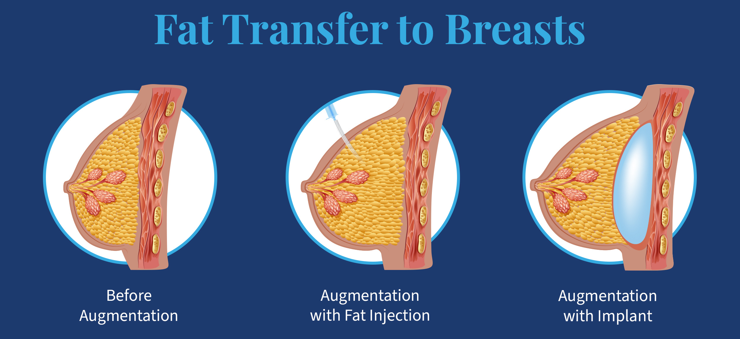 Infographic of Fat Transfer to Breasts