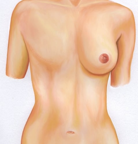 Simple Mastectomy