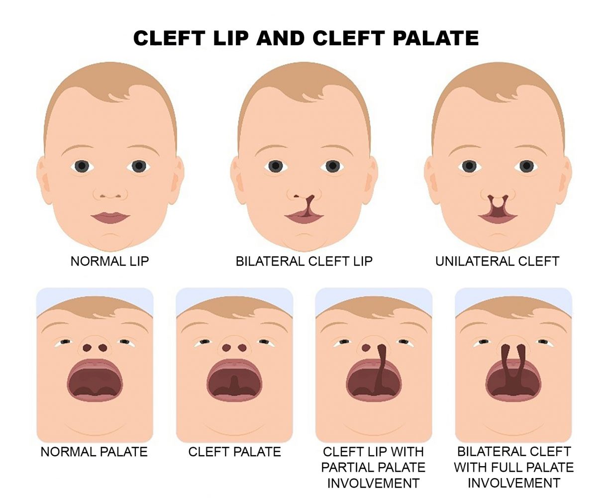 Cleft and Craniofacial Awareness Month