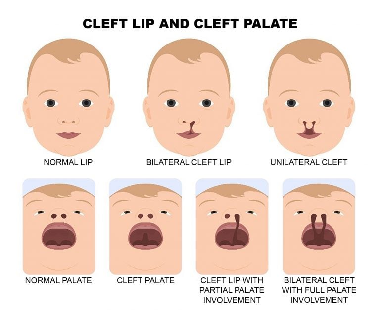 Cleft And Craniofacial Awareness Month